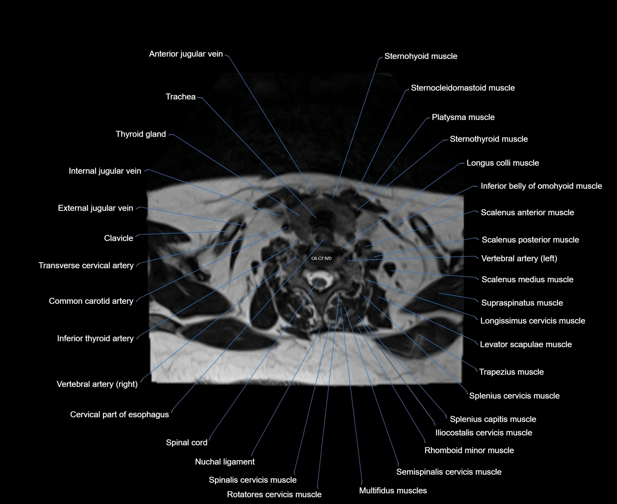 MRI Neck 3D labelled cross section anatomy axial 3t image-00001-00074.webp